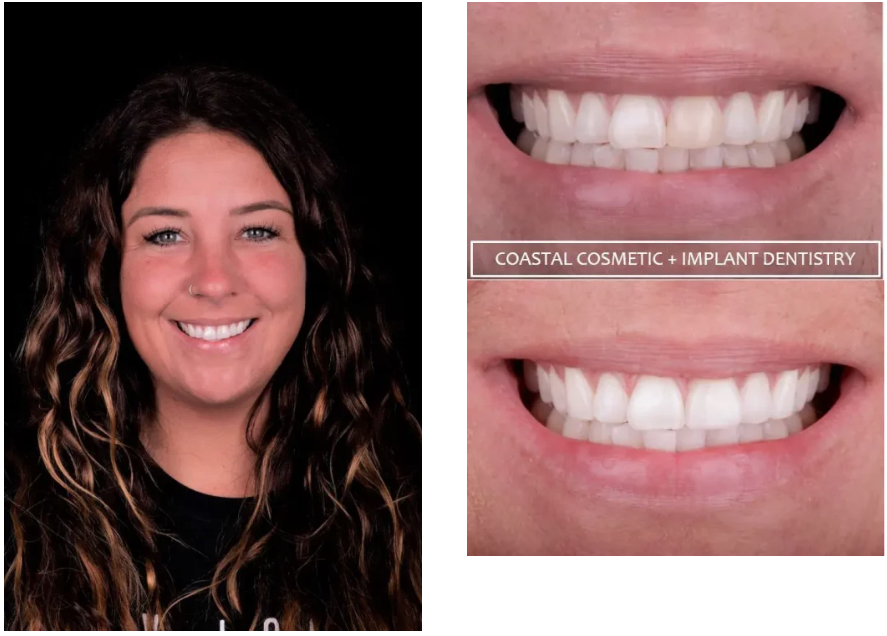 Lina before and after dental fillings at Coastal General Dentistry