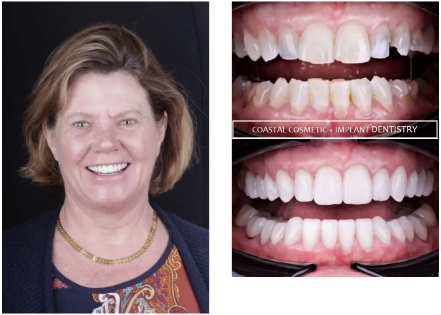 Nina before and after veneers