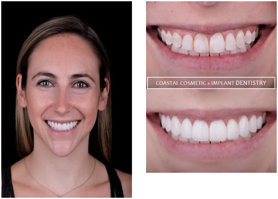 Rae before and after bonding and veneers