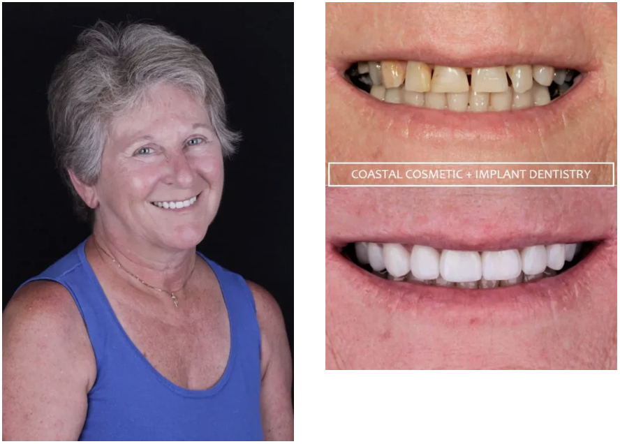 Robin before and after porcelain crown