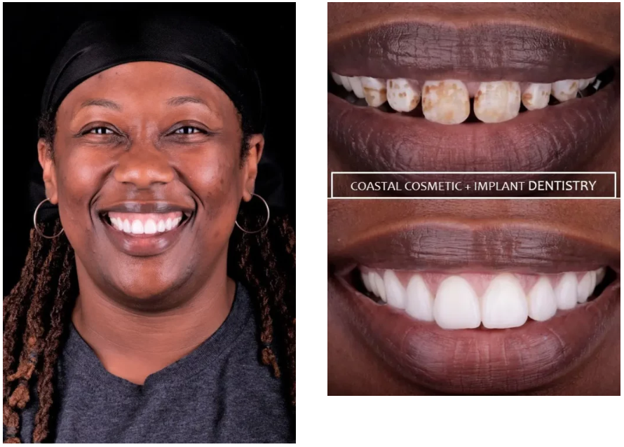 TaQuilla before and after porcelain veneers