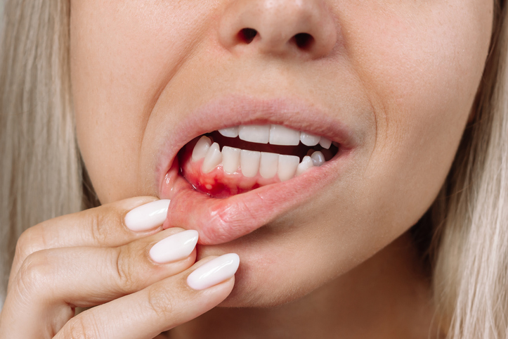 bleeding gums treatment in Virginia Beach VA