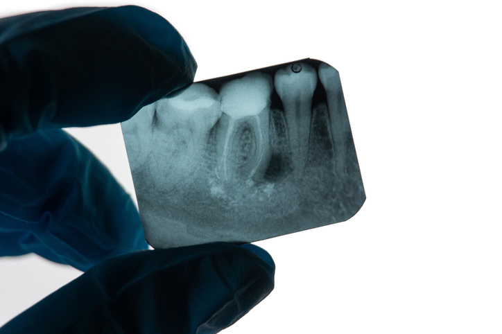 The Root Canal Anxiety Trap: Why Waiting Makes Everything Worse